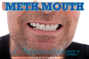 Side Effects of Abusing Crystal Meth meth mouth
